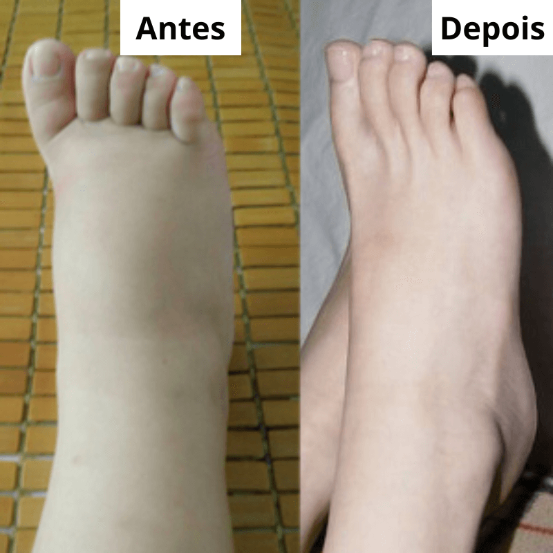 Tornozeleira Ortopédica FEET FRE